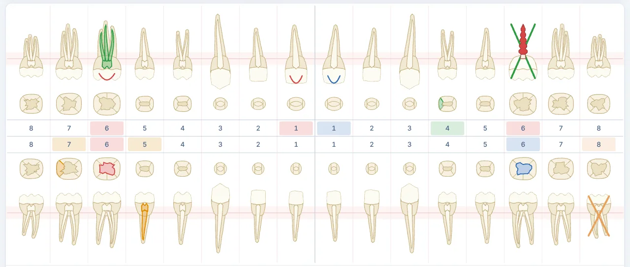 Close-up of the chart: the upper and lower arches with FDI numbers. Tooth 26 is crossed out in green with a red implant drawn over the X; tooth 16 shows green root canals; tooth 45 an orange root canal in progress; fillings coloured on their surfaces.