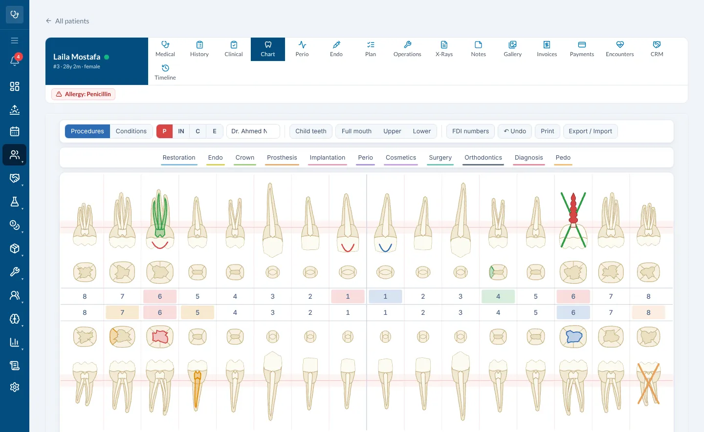 Theia’s dental chart for a demo patient. Tooth 16 has a finished root canal and a planned crown; tooth 26 is crossed out as extracted, with a planned implant drawn over the X; fillings are marked surface by surface.